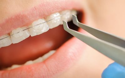 Early Signs You Might Need a Dental Filling or Crown