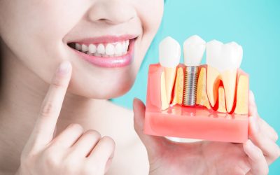 Understanding Dental Implants: A Permanent Solution for Missing Teeth