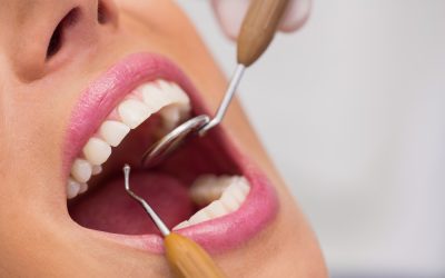 Dentures vs Crowns: Which Tooth Replacement Option Is Right for You?